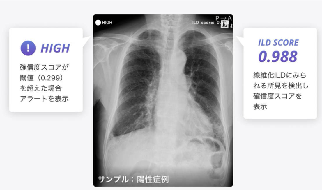 線維化伴う間質性肺疾患検出支援AI医療機器「BMAX」 承認取得・提供 