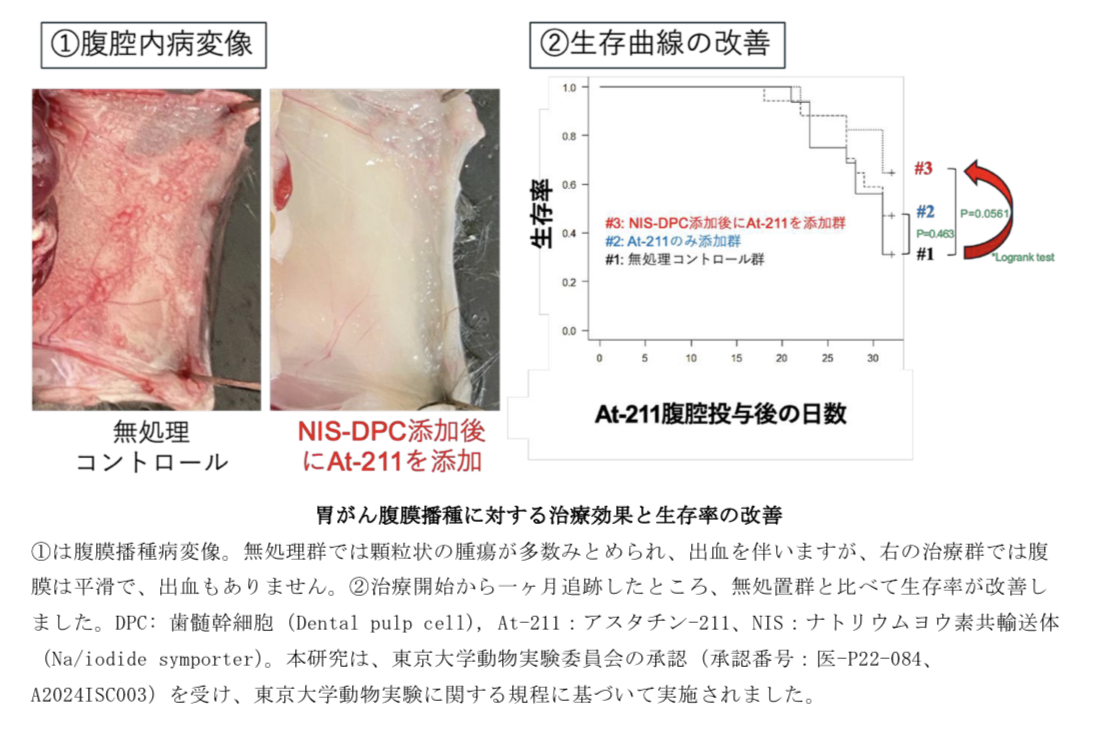 胃がん腹膜播種対象に歯髄由来幹細胞とα線を組み合わせた新たな治療法